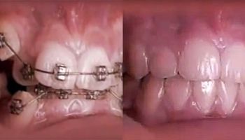 To nagranie w przyspieszonym tempie pokazuje, jak działa na zęby aparat ortodontyczny