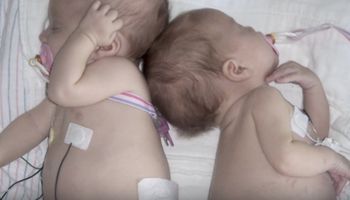 U 2-miesięcznej dziewczynki lekarz wykrył guza. Gdy zbadał jej siostrę bliźniaczkę, przeżył szok