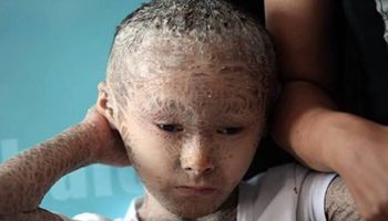 11 wyjątkowych dzieci, które z powodu swoich rzadkich chorób stały się znane na całym świecie