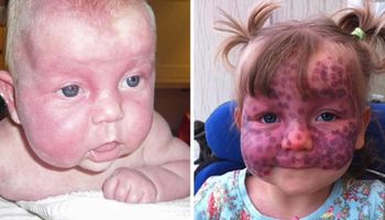 Kiedy się urodziła jej buźka miała dziwny kolor. Z wiekiem zmiana na twarzy powiększyła się