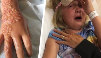 7-latka wiła się z bólu po wykonaniu tatuażu z henny. Jej ręka nie wyglądała dobrze
