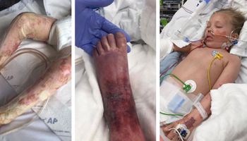 Ciało 7-latki pokryły sine plamy. Gdy mama zabrała ją do szpitala, usłyszała druzgocącą diagnozę