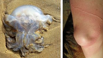 Niebezpieczne meduzy pojawiły się w Bałtyku. W weekend zostało poparzonych 90 osób