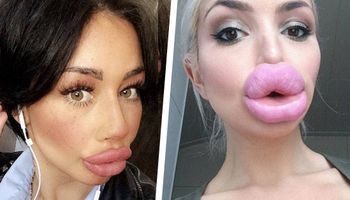 33 kobiety, które przesadziły z powiększaniem ust. Rozmiar w tym przypadku ma znaczenie