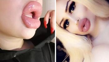 13 dziewczyn, które uważają, że ich usta są wciąż za małe. Chcą wypełniać je jeszcze bardziej