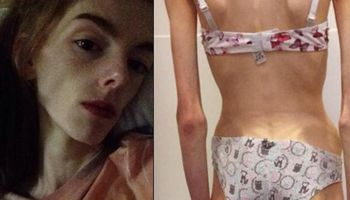 Anoreksja zniszczyła jej życie. Gdy groziła jej śmierć i ważyła 29 kg, zaczęła walkę