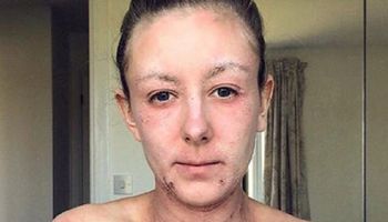 Kondycja jej skóry była w fatalnym stanie. Przestała się myć z nadzieją, że jej to pomoże