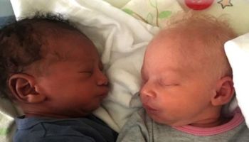 W Łodzi urodziły się bliźnięta o różnych kolorach skóry. „To prawdziwa rzadkość!”