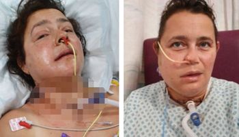 47-letnia kobieta przeszła rekonstrukcję twarzy po usunięciu nowotworu