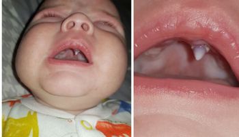 Dziwny ząb wyrósł w ustach maluszka. Lekarze byli zdumieni, gdy go zobaczyli
