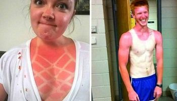 23 osoby, które raczej się spaliły niż opaliły. Słoneczne problemy wczasowiczów