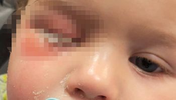 opiekunka w żłobku wlała klej do oka dziecka