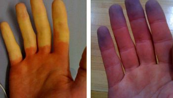 Twoje palce robią się białe lub sine podczas mrozu? To może być objaw choroby
