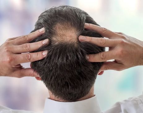 Komórki macierzyste, terapie genowe i laseroterapia. Nowe technologie w walce z łysieniem