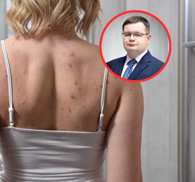 Domowe sposoby na leczenie kurzajek. Dermatolog przestrzega