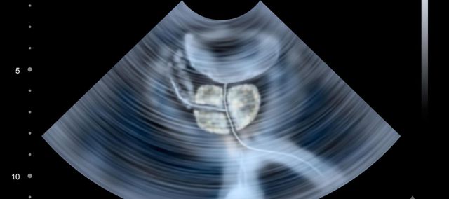 powiekszona prostata a psa powiekszona prostata a psa