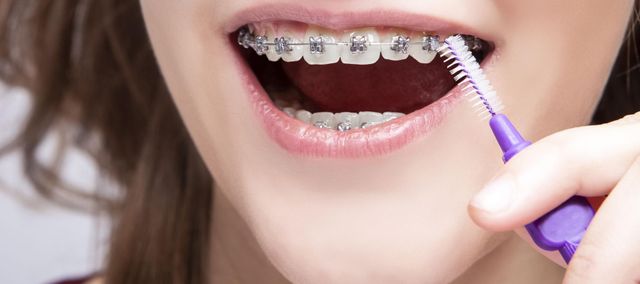 Aparat Ortodontyczny Rodzaje Wskazania Przeciwwskazania I Cena Wp Abczdrowie