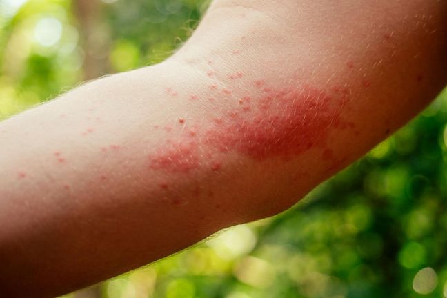 Objawy alergii na słońce. Dotyka dzieci i dorosłych | WP parenting
