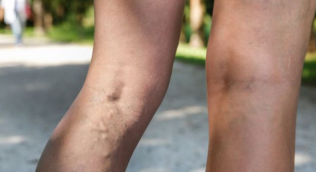 Objawy Zakrzepicy Opuchlizna Nog Pajaczki Podwyzszona Temperatura Rozgrzana Skora Wp Abczdrowie