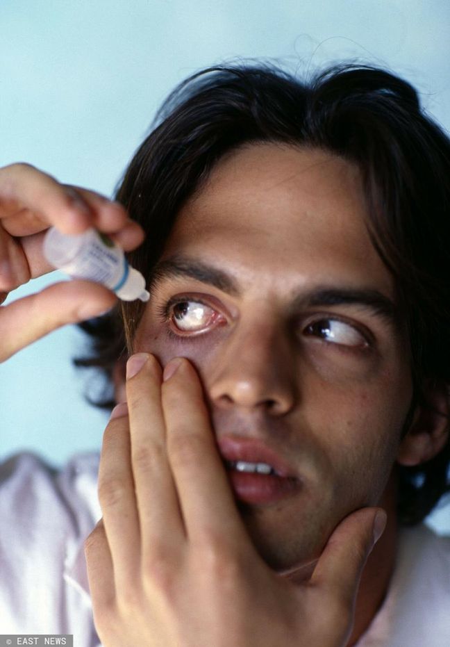 Przekrwione Oczy Mogą Oznaczać Chorobę Nie Przegap Tych Objawów Wp Abczdrowie 6033