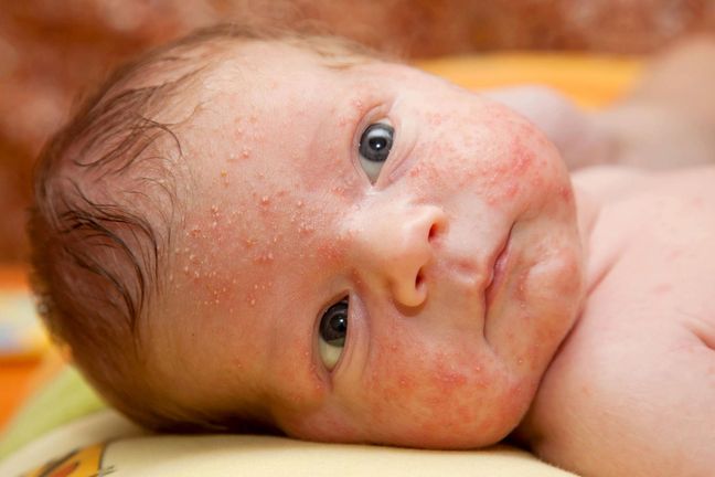 Wysypka U Dziecka Alergia Choroby Infekcje Wp Parenting
