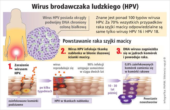 Hpv A Co To Jest Wp Kobieta