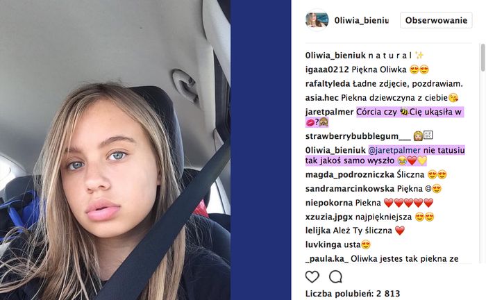 Czy Oliwia Bieniuk stosuje botoks?