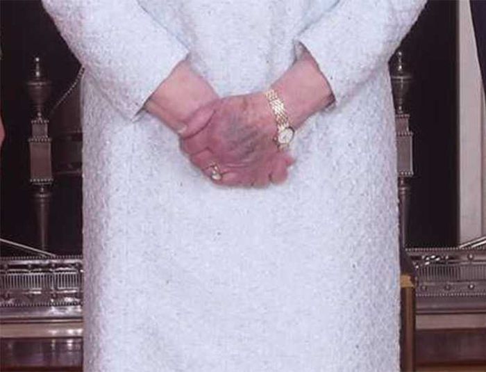 Królowa Elżbieta II z posiniaczonymi rękami