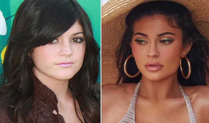 Kylie Jenner przed i po zabiegu powiększającym usta