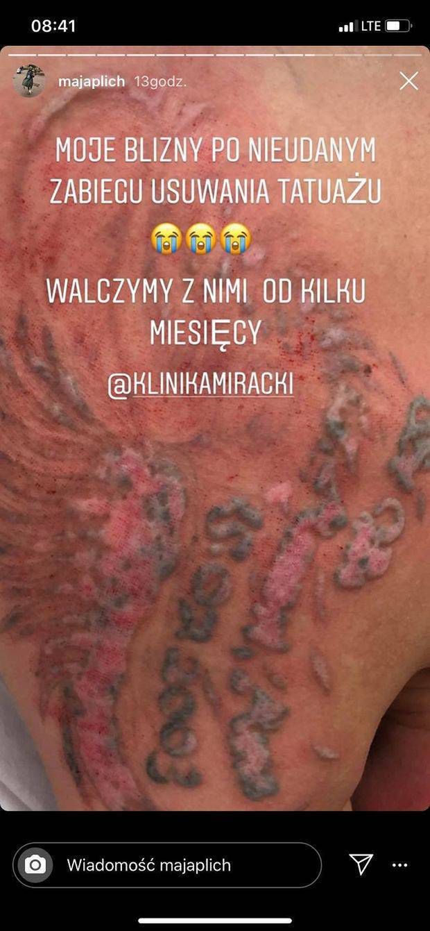 Maja Plich - tatuaż w trakcie usuwania