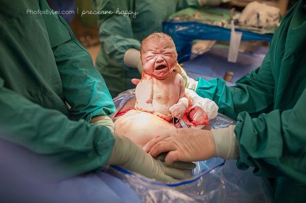 this baby was born by c-section