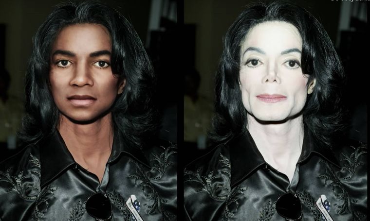 Michael Jackson bez operacji