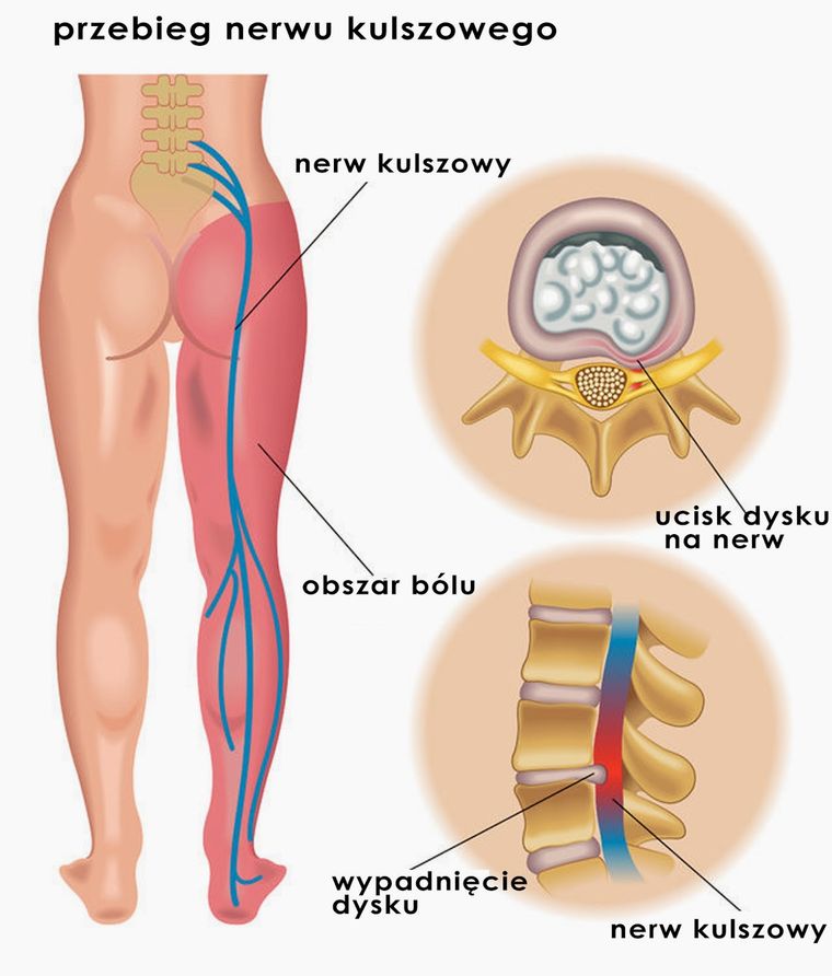 Rwa kulszowa - rysunek obrazujący przebieg nerwu kulszowego