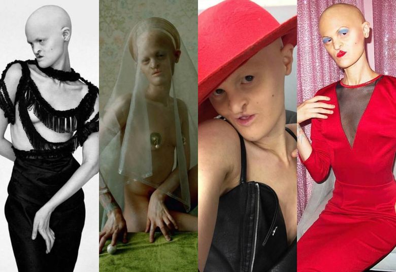 2Oto Melanie Gaydos - modelka z chorobą genetyczną i MUZA NERGALA