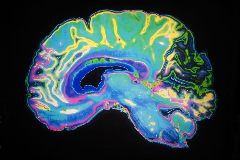 Mózg osoby chorej na Alzheimera. Daisy Daisy/Shutterstock