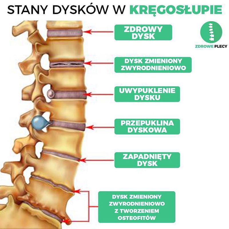 icd 10 zwyrodnienie kręgosłupa piersiowego