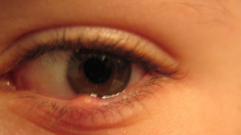 7 symptomów chorobowych oczu, które mogą świadczyć o zaburzeniach w całym organizmie!