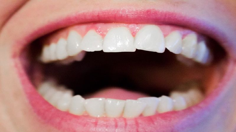 Czy usuwanie zębów mądrości naprawdę jest konieczne? Oto cała prawda na ten temat