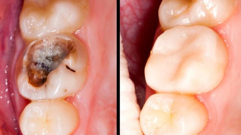 5 prostych i naturalnych kroków na zapobieganie próchnicy i dziurom w zębach. Żegnajcie plomby!
