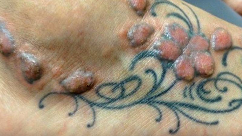 3 długoterminowe zagrożenia wynikające ze zrobienia sobie tatuażu. Można się przestraszyć!