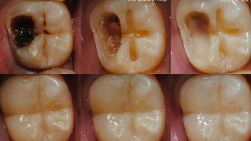 5 szybkich kroków do naprawienia ubytków w zębach. Obejdzie się bez dentysty!