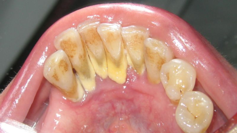 13 sposobów na pozbycie się płytki nazębnej i kamienia gromadzącego się na szkliwie zębów