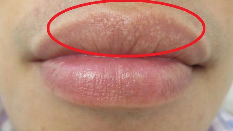 Te małe plamki na ustach nie znajdują się na nich przypadkowo. Jak się ich skutecznie pozbyć?