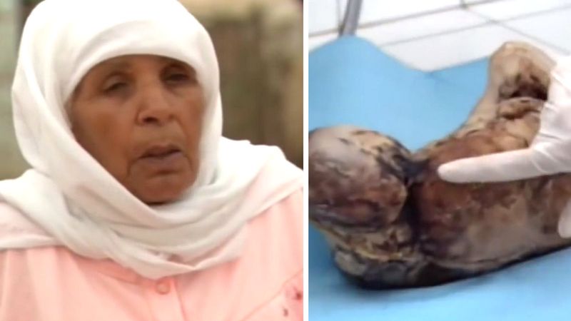 84-latka nosiła skamieniały płód przez 44 lata. Nie miała o tym pojęcia
