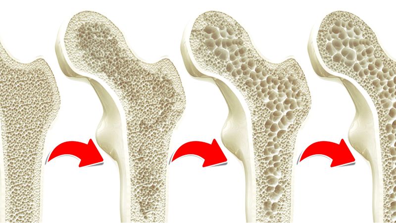 Osteoporoza to plaga XXI wieku. Przybliża Cię do niej aż 9 nawyków!