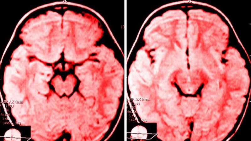 Neurolodzy odkryli co narzekanie robi z mózgiem. Jest tylko jeden sposób, by cofnąć zmiany