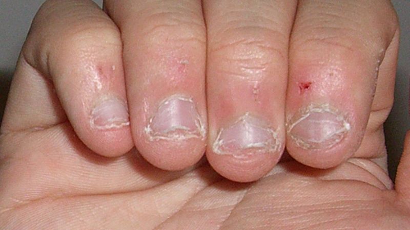 6 przykrych konsekwencji obgryzania paznokci. Skuteczny odstraszacz