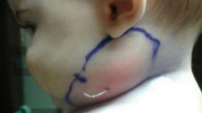 7-miesięczna dziewczynka miała obrzęk na policzku. Jako rodzic powinieneś poznać okoliczności