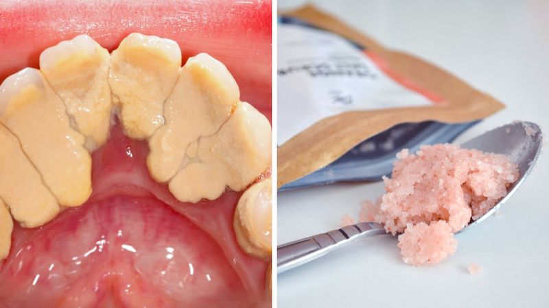 2 produkty, które skutecznie usuwają kamień nazębny. Dentyści o nich nie mówią