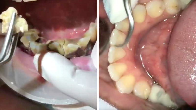 Satysfakcjonujące video z usuwania kamienia nazębnego. Nie unikaj dentysty!